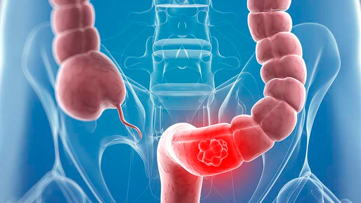 Un cáncer colorrectal.