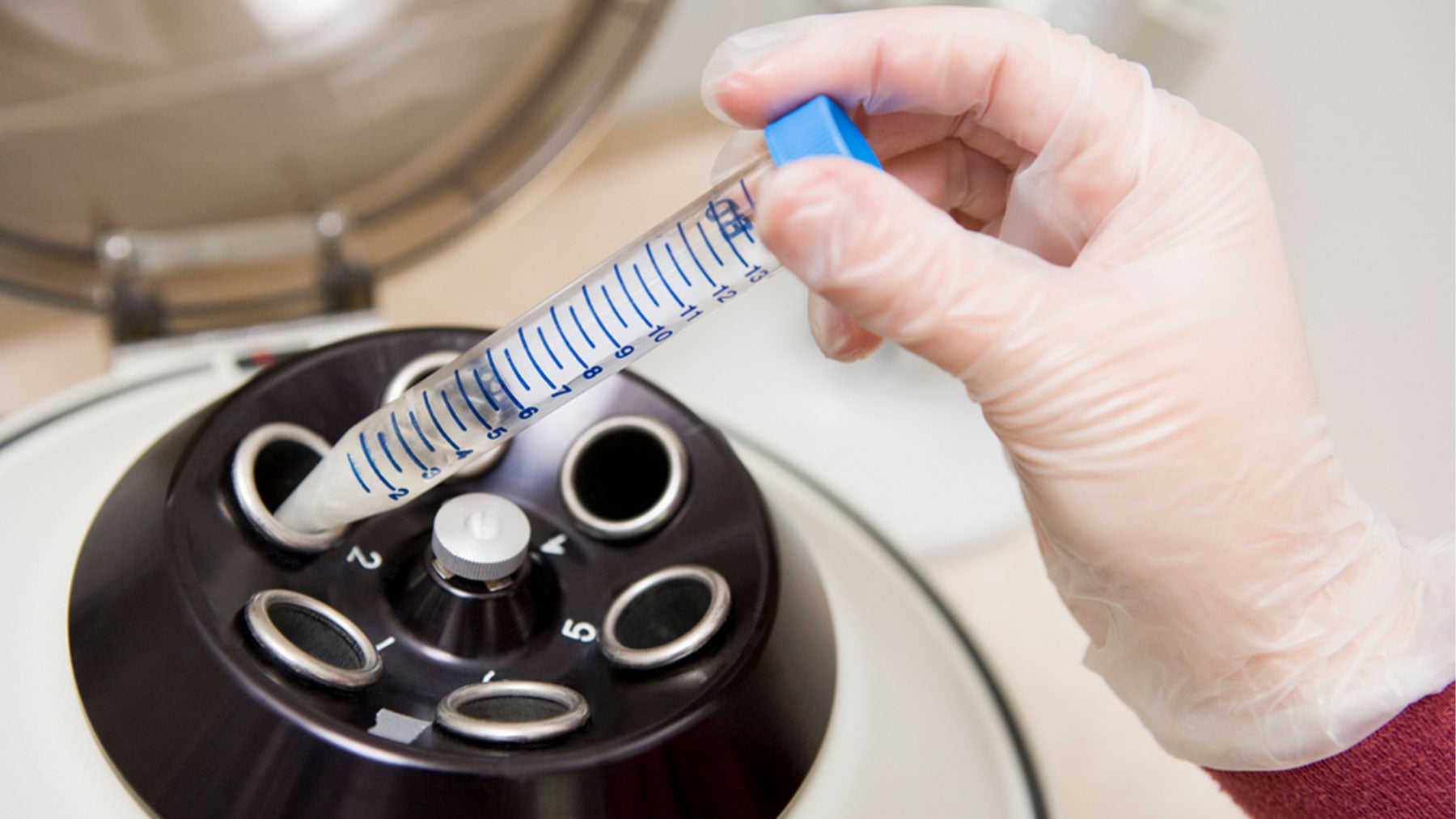 Una muestra de semen en el laboratorio.